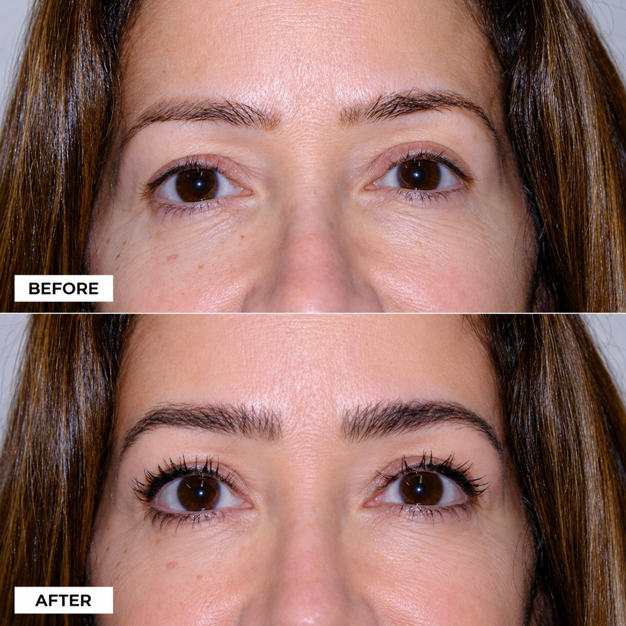 Before and after eyebrow transplant at ReGrow Medical Los Angeles — close-up showing natural eyebrow regrowth