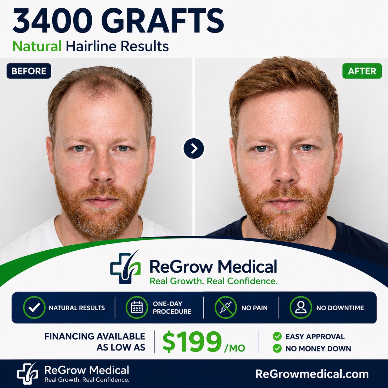 3400 graft FUE hair transplant before and after — male patient showing dramatic transformation at ReGrow Medical Orange County