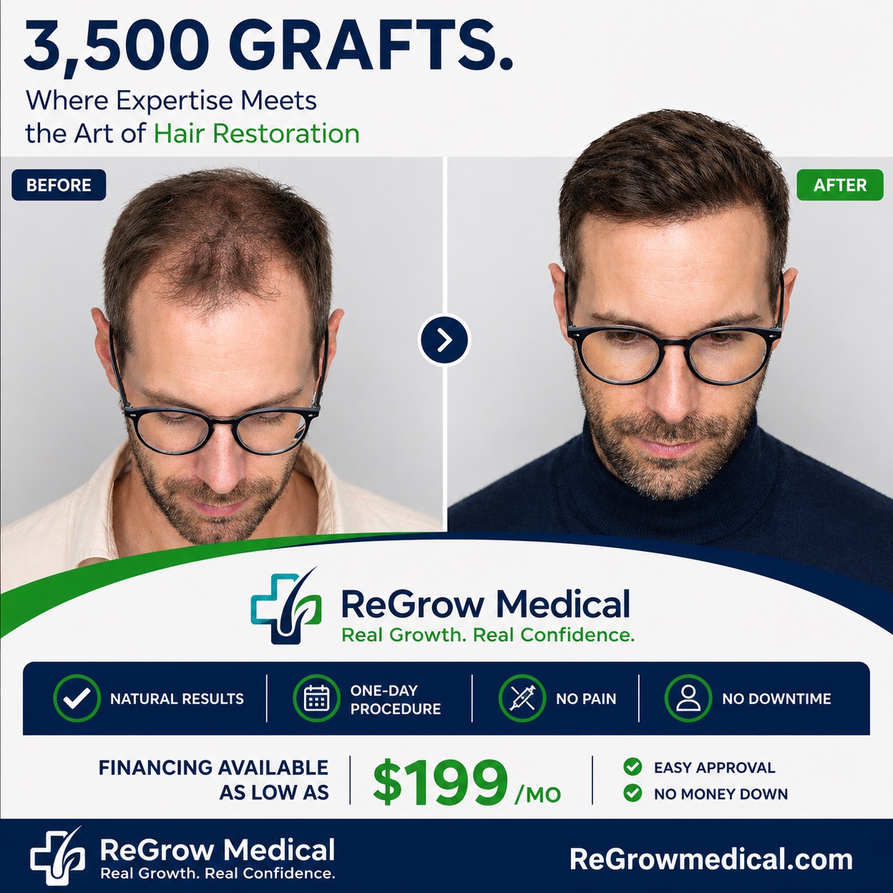 3,500 graft FUE hair transplant result at ReGrow Medical — natural hairline restoration