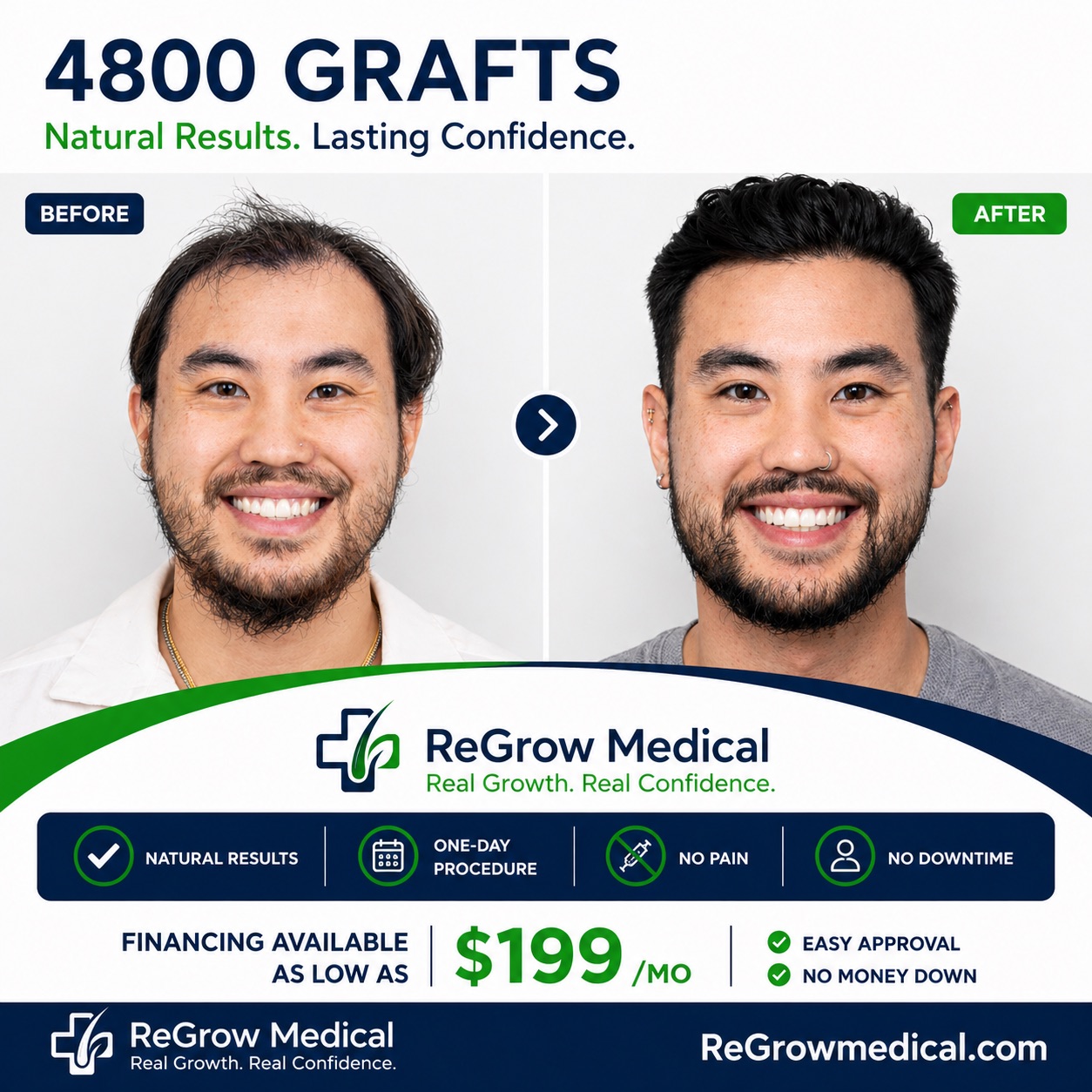 Before and after 4,800 graft FUE hair transplant at ReGrow Medical — full hair restoration