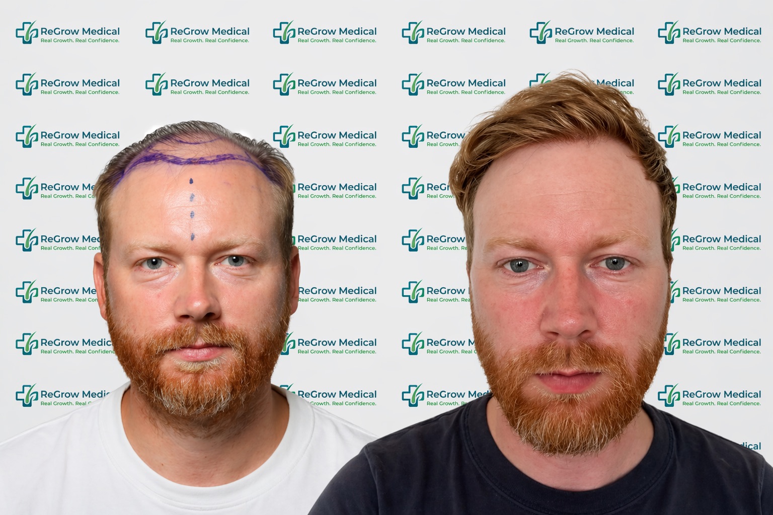 ReGrow Medical FUE patient before treatment with a marked frontal hairline and after frontal hair restoration