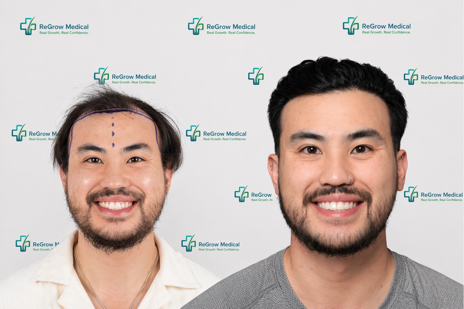 Hair transplant before and after — Asian male patient showing dramatic hairline restoration and density improvement at ReGrow Medical Irvine