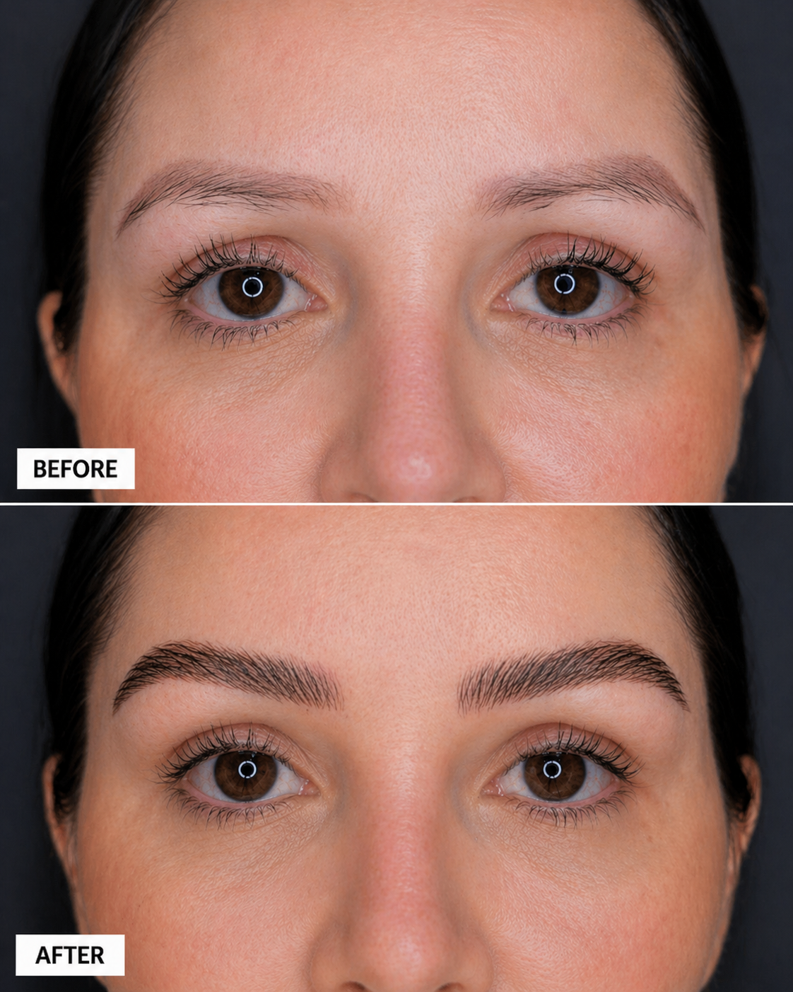 ReGrow Medical — Sparse Brow Correction