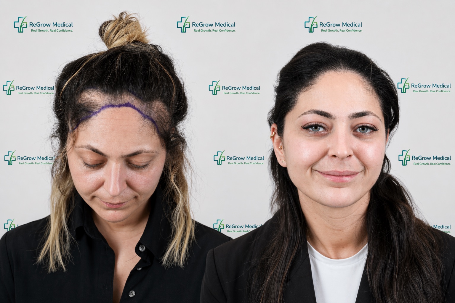Female patient before and after FUE hair transplant at ReGrow Medical — hairline and frontal density restored