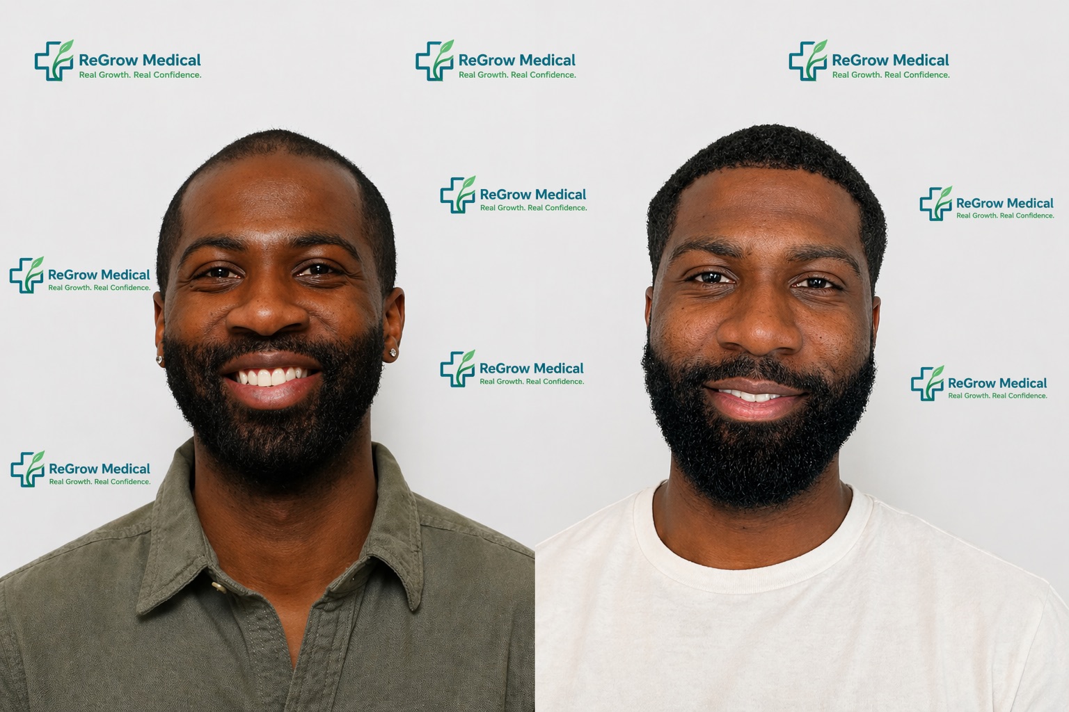 FUE hair transplant before and after — male patient showing natural hairline restoration result at ReGrow Medical