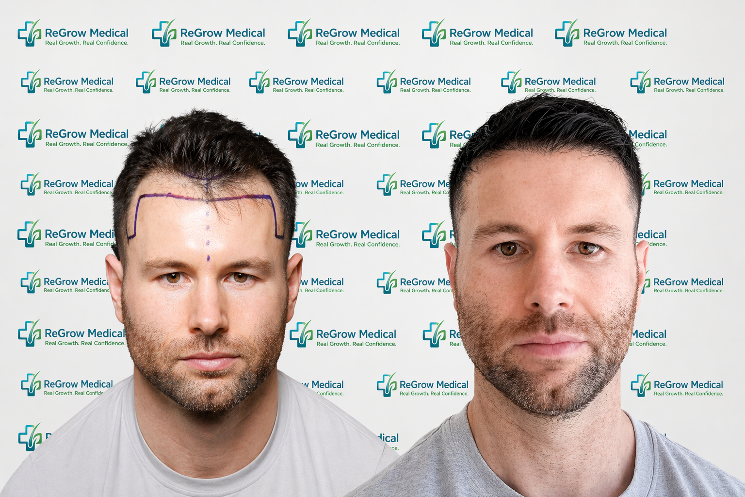 ReGrow Medical — Full Hairline Restoration