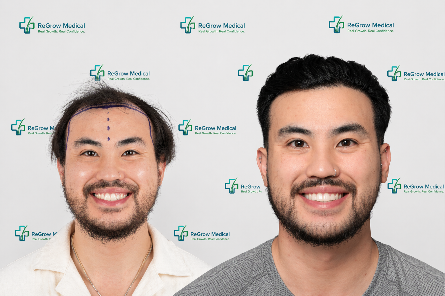 ReGrow Medical — Natural Hairline