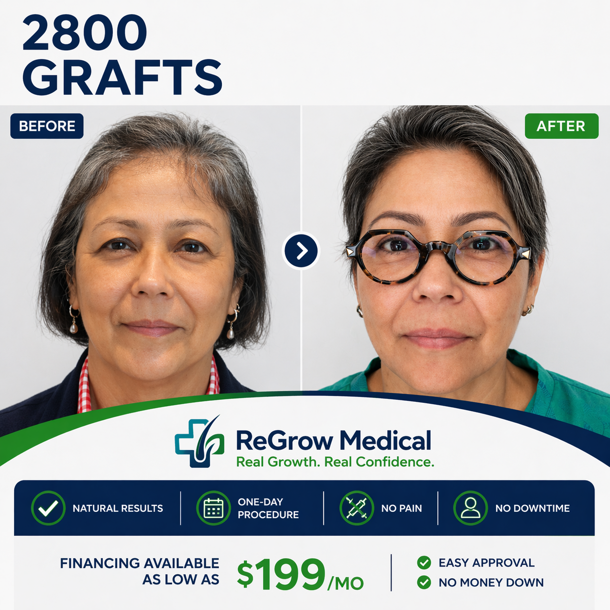 Women's Hair Restoration Before and After — 2800 Grafts — ReGrow Medical