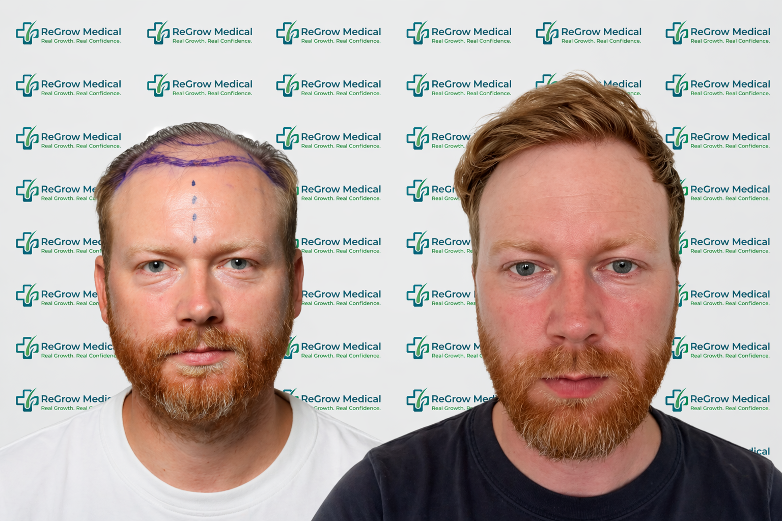 Side-by-side before-and-after photographs of a ReGrow Medical hair restoration patient
