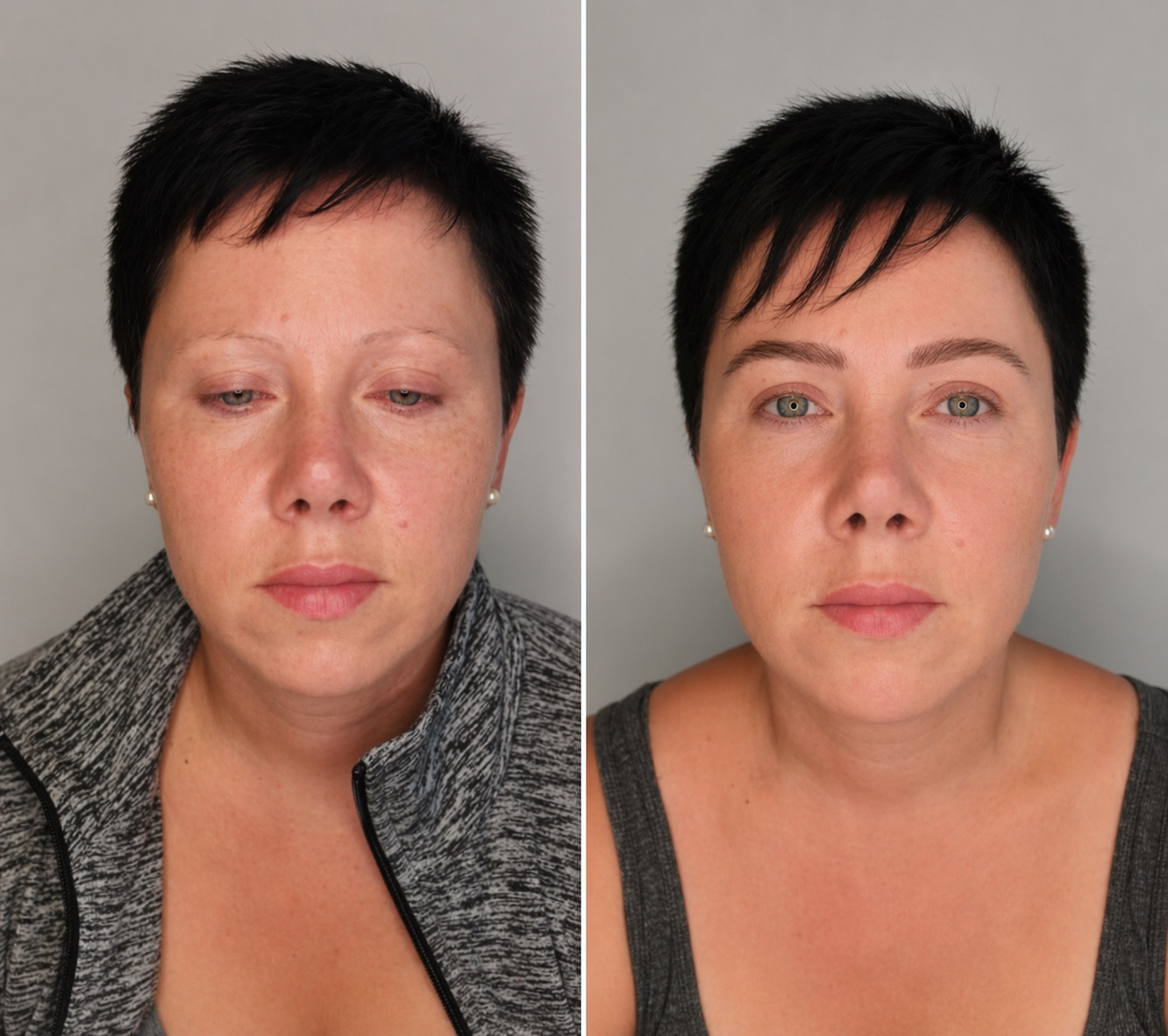Eyebrow restoration comparison: before on the left and 12–18 months after on the right