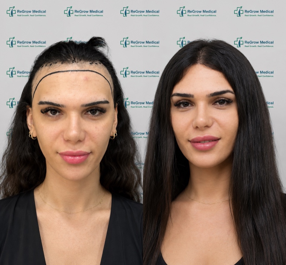 ReGrow Medical female hair restoration comparison 26: Female Hairline Restoration; before on the left and after on the right