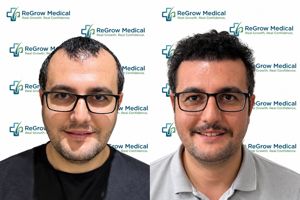 ReGrow Medical hair restoration comparison 38: Hairline & Frontal Coverage; before on the left and after on the right