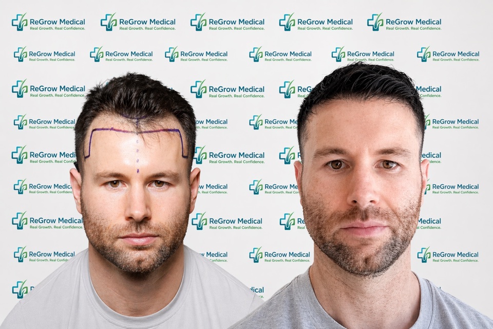 ReGrow Medical hair restoration comparison 5: Full Hairline Restoration; before on the left and after on the right